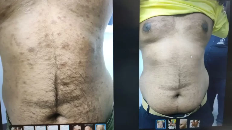 Secondary Syphilis